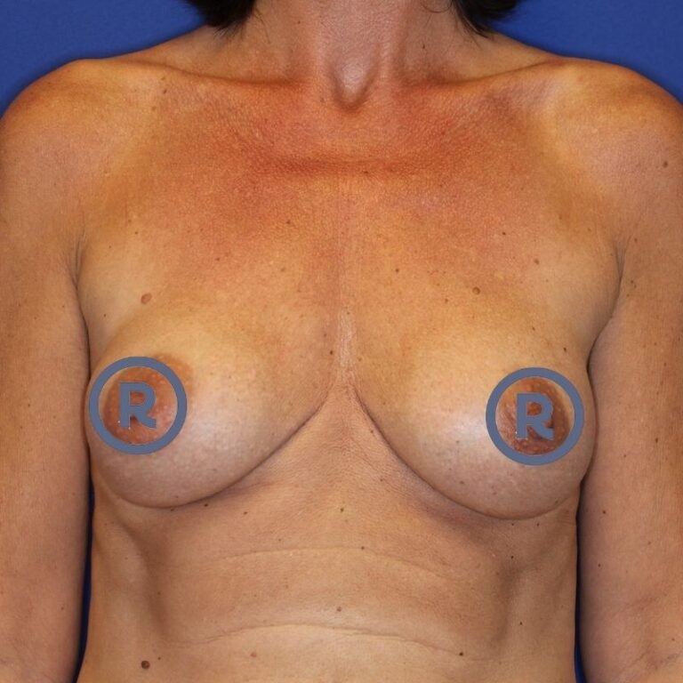 Brustvergrößerung mit Implantaten vorher
