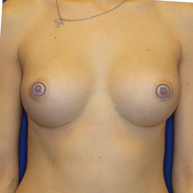 Brustvergrößerung mit Implantaten nachher