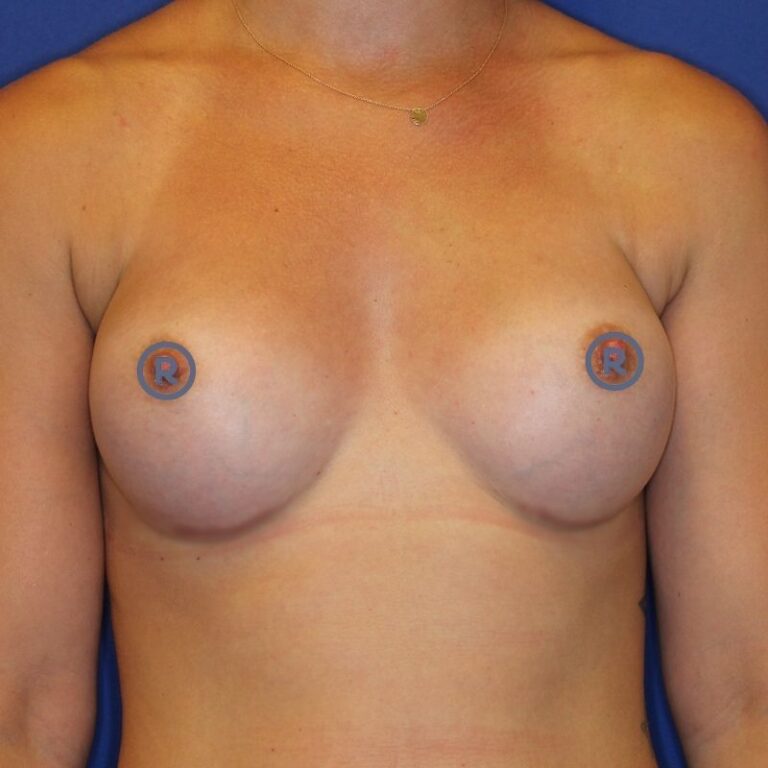 Brustvergrößerung mit Implantaten nachher