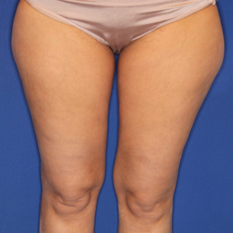 Fettabsaugung Beine Reiterhosen vorher
