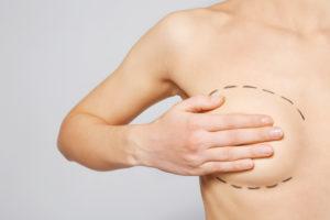 Brustvergrößerung mit Eigenfett, Fettabsaugung an anderen Körperstellen